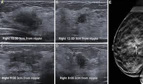  3D breast screening Koning Vera technology UK